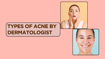 Acne Treatment